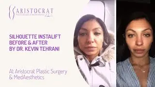 Silhouette InstaLift Before & After by Dr. Kevin Tehrani