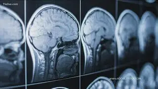 VERIFY: If you&rsquo;re listed as an organ donor on your license, does that include your brain?