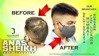 Short cut hair patch look ! Permanent hair patch solution ! Lucknow 9625587340 ! Delhi 9650914665