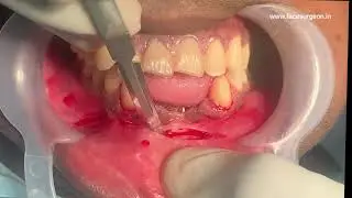 Wrongly Inserted Plates and Screws Compressed the Nerve, removed by Dr Sunil Richardson
