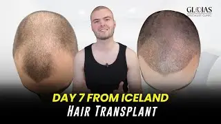 Hair Transplant in Malaysia | Sam&rsquo;s Full Experience from Iceland 🇮🇸 | Glojas Clinic Review
