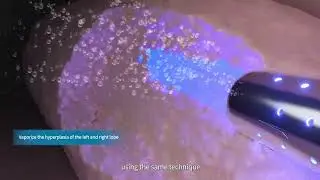 Revolutionizing BPH Surgery | Blue Laser Vaporization: Faster, Safer, Minimally Invasive