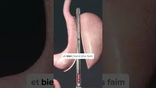 La Sleeve gastrectomie