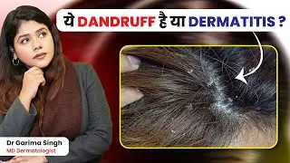 Dandruff ya Seborrheic Dermatitis? White Flakes, Redness & Itching Ka Sach | Dermatologist Explains