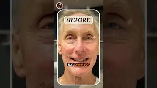 ✨ J Lift&trade; Instant Face-Lift | Non-Surgical Facelift in 30 Minutes ✨