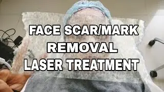FACE LASER TREATMENT for SCAR REMOVAL | CHICKEN POX SCAR, ACNE SCAR REMOVAL TREATMENT |