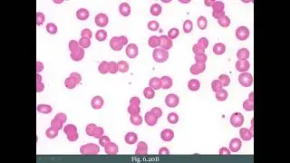Plasma Cell Disorders 