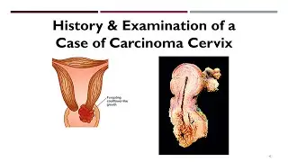 Carcinoma Cervix Case: History Taking & Clinical Examination | Step-by-Step OBGYN Guide