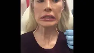 Botox for neck