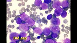 Promyelocytic Leukemia, 20 patients
