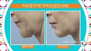 Get surgical results without the surgery with FaceTite & BodyTite| HOUSTON LIFE | KPRC 2