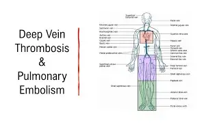 Venous Thromboembolic Disease (DVT and PE)