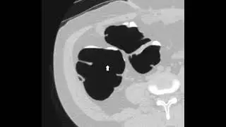 Polyp in the ascending colon