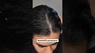 Best Anti Dandruff Shampoo For Men