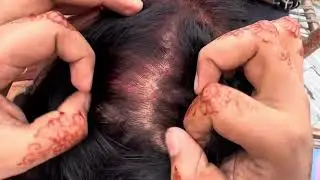 #nitsremoval wife removed husband lices 🔥 nitpicking by husband hair 🔥part 10