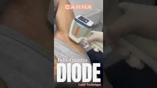 World&rsquo;s most effective Diode Laser - 4 wavelengths ai technology #diodelaserhairremoval #diodelaser