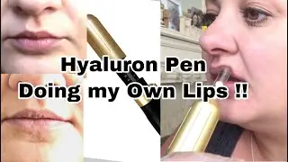 Hyaluron Pen - Lip Filler - Doing Own Lips