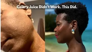 What I Drank Instead of Celery Juice to Heal My Skin & Inflammation