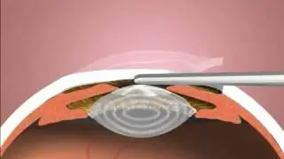 Intraocular Lens Surgery - Eye Associates of Colorado Springs