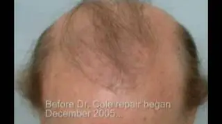 Forhair.com - Body Hair - Repair -patient 3 - Dr. Cole