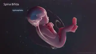 Spina Bifida 3D Animation - UNC Health Department of Neurosurgery