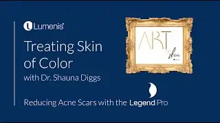Acne Scar Reduction With Legend Pro By Lumenis - Dr. Shauna Diggs