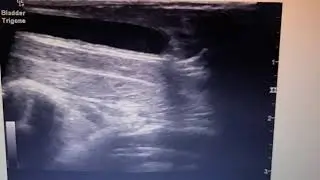 bladder trigone
