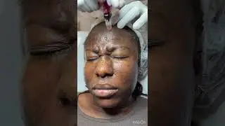 Acne Treatment  #skintoskincontact #skintreatment #acnetreatment #acneskincare #cosmeticdermatology