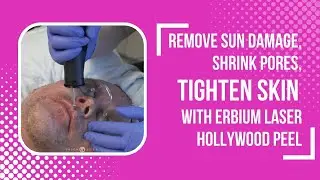 REMOVE SUN DAMAGE, SHRINK PORES, TIGHTEN SKIN WITH ERBIUM LASER HOLLYWOOD PEEL | Dr. Jason Emer