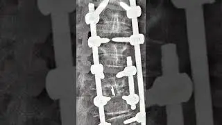 Revision spine surgery : successful outcome Adjacent segment disease ‪@Sanchetispinepune‬ #pune