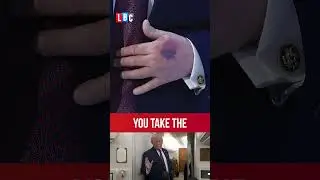 Trump explains away bruised left hand