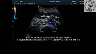 Inferior Vena Cava (Courtesy of Dr. Mi-Sun Hur)
