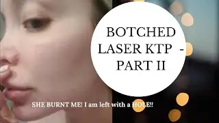 UPDATE MY BOTCHED LASER KTP - BROKEN CAPILLARIES REMOVAL GONE WRONG BURNT LEFT WITH A HOLE
