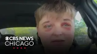 Carpentersville, Illinois beating victim presses for hate crime charges