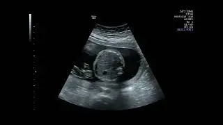 Ecograf&iacute;a Scan Fetal 21,5 