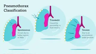 PNEUMOTHORAX TYPES,CLINICAL FEATURES #neet #usmle #marrow #uworld #mbbs #pathology #medicine 