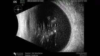 20 MHz Annular Ophthalmic Ultrasound ABSolu, Subhyaloid hemorrhage , 36924