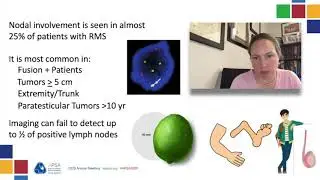 RMS: Extremity rhabdomyosarcoma- APSA 2020