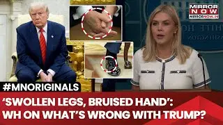 Trump's 'Swollen Legs, Bruised Hand' Linked To Chronic Vein Disease? White House Reveals What Is It?