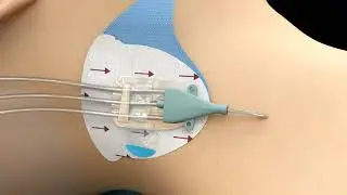 3M&trade; PICC/CVC Securement Dressing Application Video