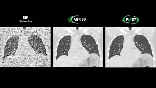 FIRST Integrated Ultra Low Dose Chest
