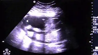 20 weken echo