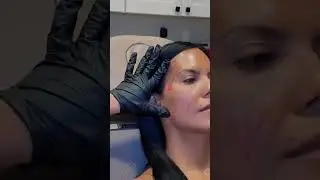 Why Everybody Wants Sculptra ✨ The Secret to Ageless Glow
