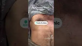 Gynecomastia surgery in Lahore Pakistan . Man boob surgery