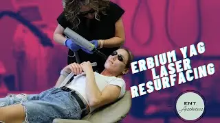 Erbium YAG Laser Resurfacing