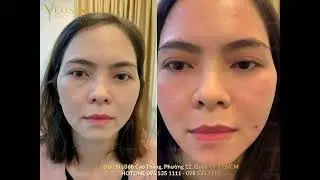 Giải ph&aacute;p l&agrave;m s&aacute;ng quầng mắt với HA Collagen tại Yeosin&ndash; chỉ 999K #shorts #xuhướng #thammat #lamdep 