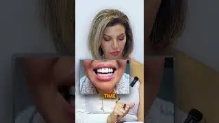 Veneers: The Secret to a Perfect Smile in Phoenix!