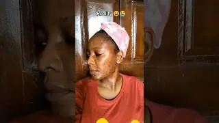 Using Tretinoin gel: Expectations VS Reality 😫#skincare #acne #oilyskin #acnescars #tretinoin