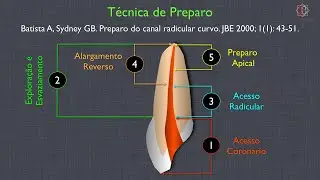 T&eacute;cnica Crowm Down - A&ccedil;o Inox