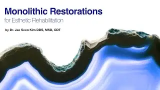 Maxillary rehab with Monolithic Ceramic Crowns